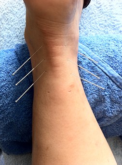 acupuncture-1211182__340